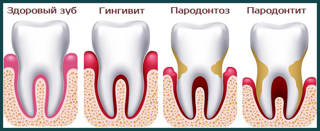 Парадонтит. Лечение в стоматологии Династиа стом